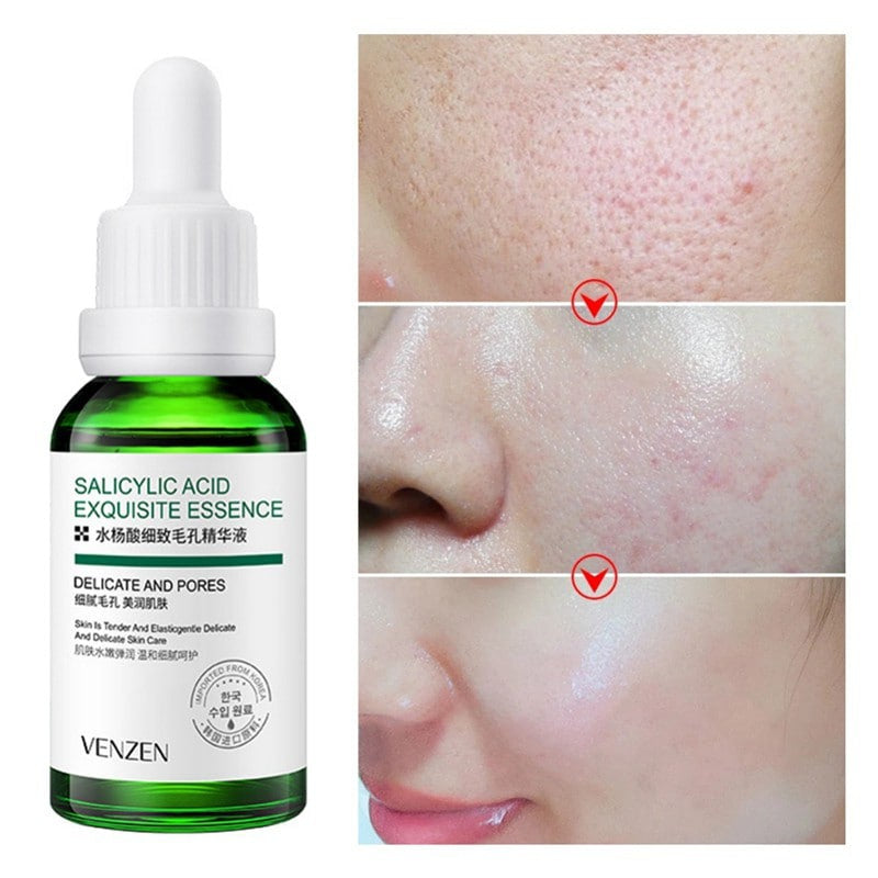 Kit/Combo x 5 Ácido Salicílico Anti-Acné | Tratamiento Facial Para El Acné - BIOAQUA
